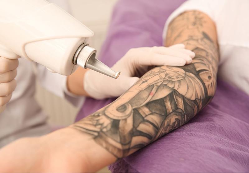 laser tattoo removal columbus ohio